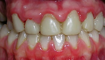 как выглядит Гипертрофический гингивит