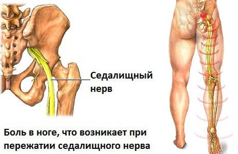 воспаление седалищного нерва причины