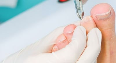 вросший ноготь лечение