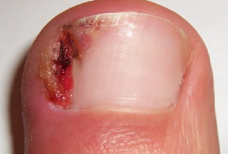 вросший ноготь на ноге фото