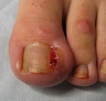 вросший ноготь на ноге