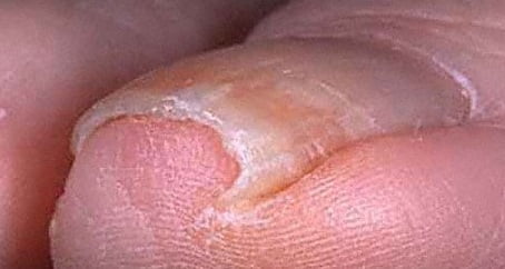 вросший ноготь причины