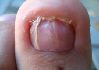 вросший ноготь симптомы
