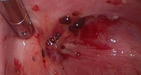 Аденомиоз матки фото