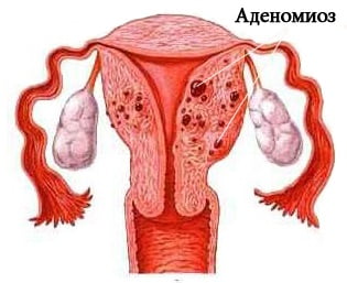 Аденомиоз матки причины