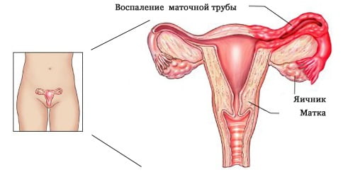 Аднексит причины
