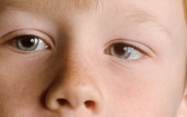 Амблиопия лечение