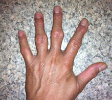 Артрит пальцев рук фото