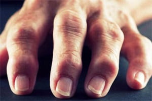 Артрит пальцев рук причины