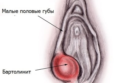 Бартолинит симптомы