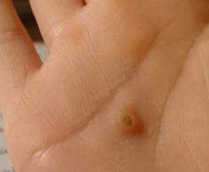 Бородавки на руках фото