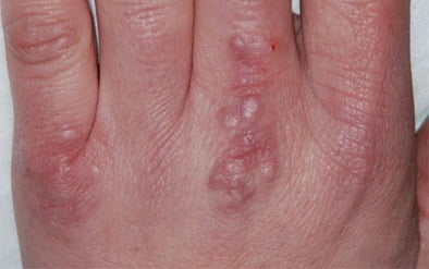 Бородавки на руках лечене