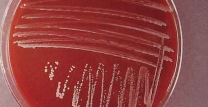 Бруцеллез у человека лечение