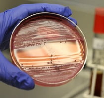 Бруцеллез у человека