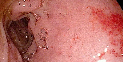 Дуоденит фото