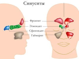 Фронтит причины