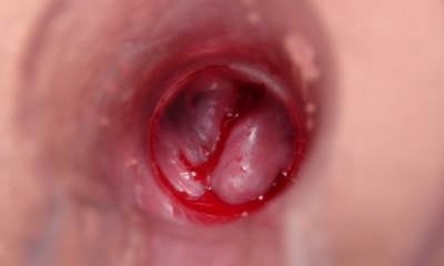 Внутренний геморрой