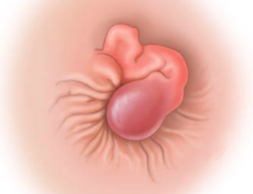 Наружный геморрой