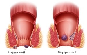 Геморрой у мужчин признаки