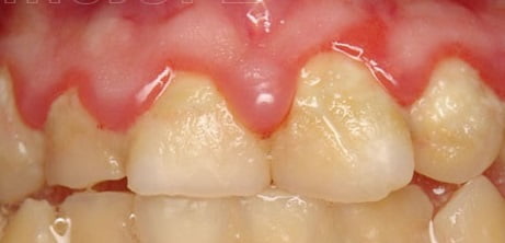 Гингивит фото