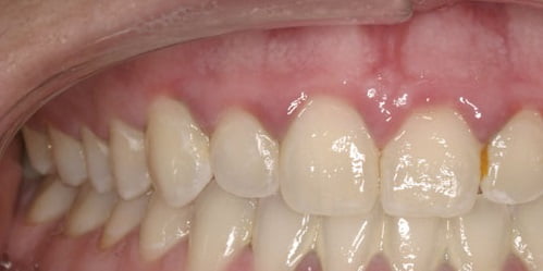 Гингивит лечение