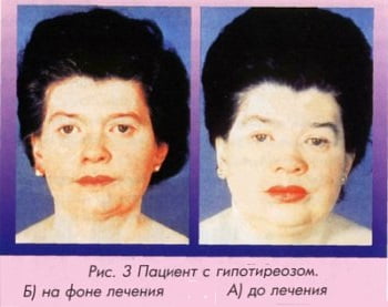 Гипотиреоз фото