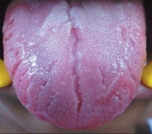 Глоссит лечение