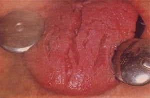 Глоссит языка фото