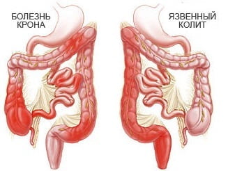 Колит кишечника причины