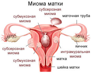 Миома матки причины