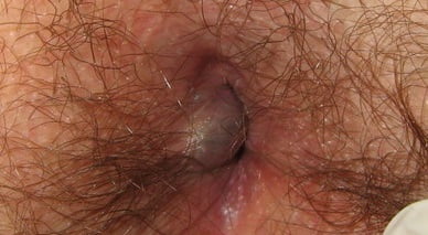 Начальная стадия геморроя фото