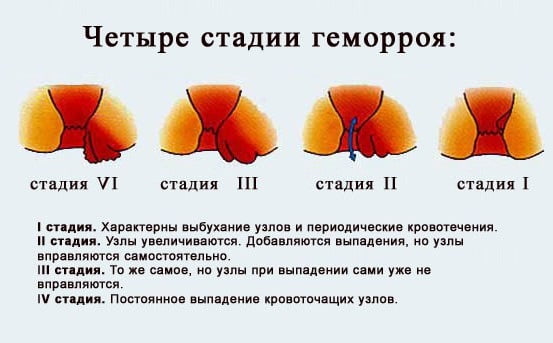 Начальная стадия геморроя причины