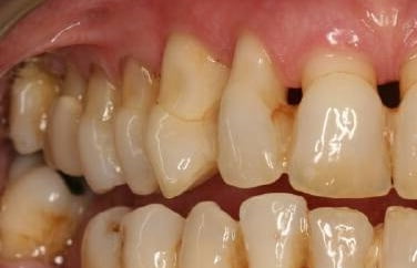 Пародонтоз лечение