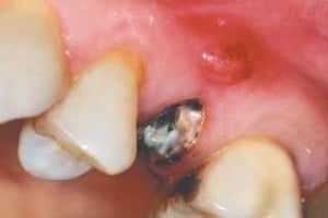 Периодонтит фото