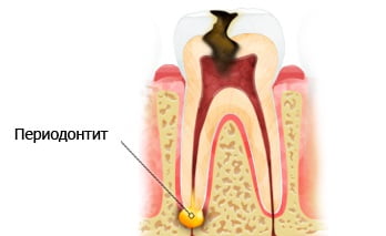 Периодонтит причины