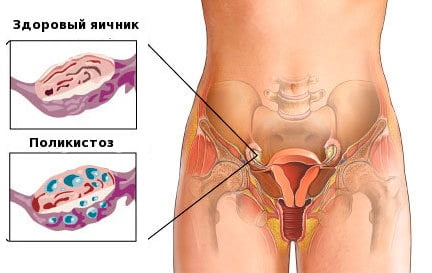 Поликистоз яичников причины