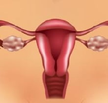 Поликистоз яичников