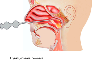 Прокол пазухи синусит