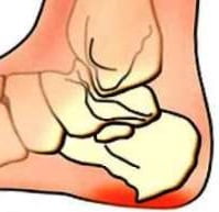 Пяточная шпора