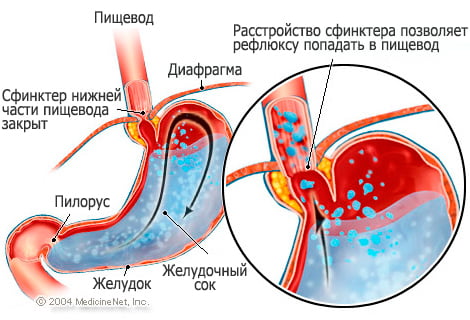 Рефлюкс эзофагит причины