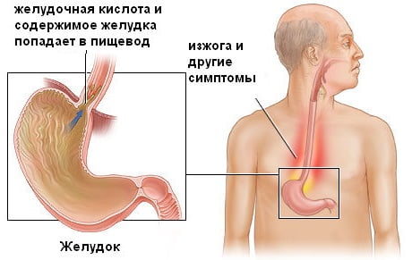 Рефлюкс эзофагит симптомы