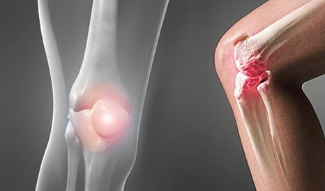 Ревматизм лечение