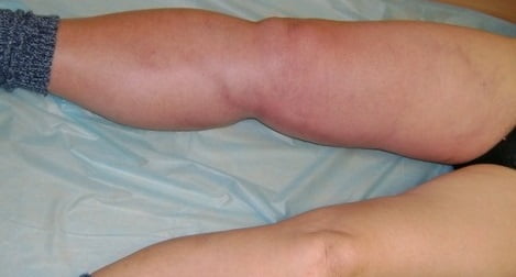 Тромбофлебит глубоких вен фото