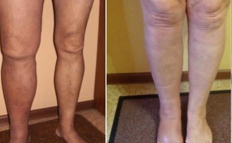 Тромбофлебит глубоких вен симптомы