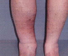 Тромбофлебит глубоких вен