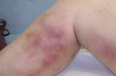 Тромбофлебит нижних конечностей фото