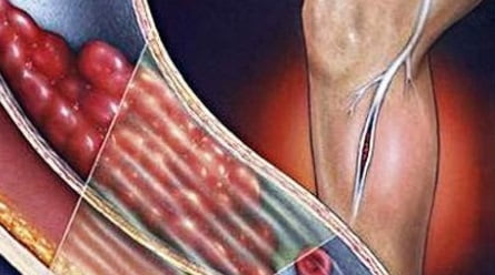 Тромбофлебит нижних конечностей лечение