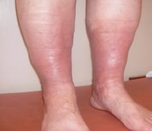 Тромбофлебит нижних конечностей