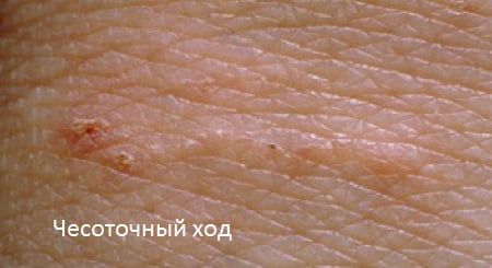 чесоточный ход