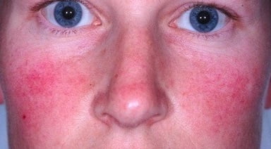 розацеа фото